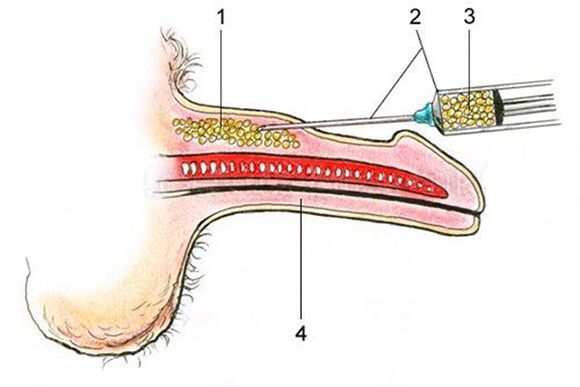 Lipofilling - introducerea de țesut gras în axul penisului