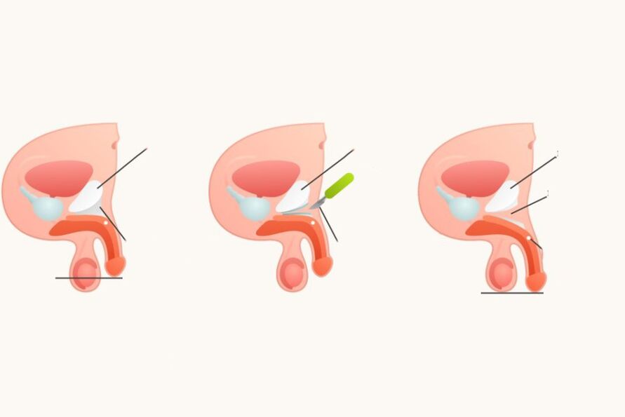 Ligamentatomie pentru a crește penisul