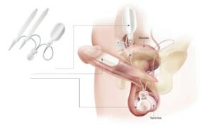Introducerea implanturilor în penis